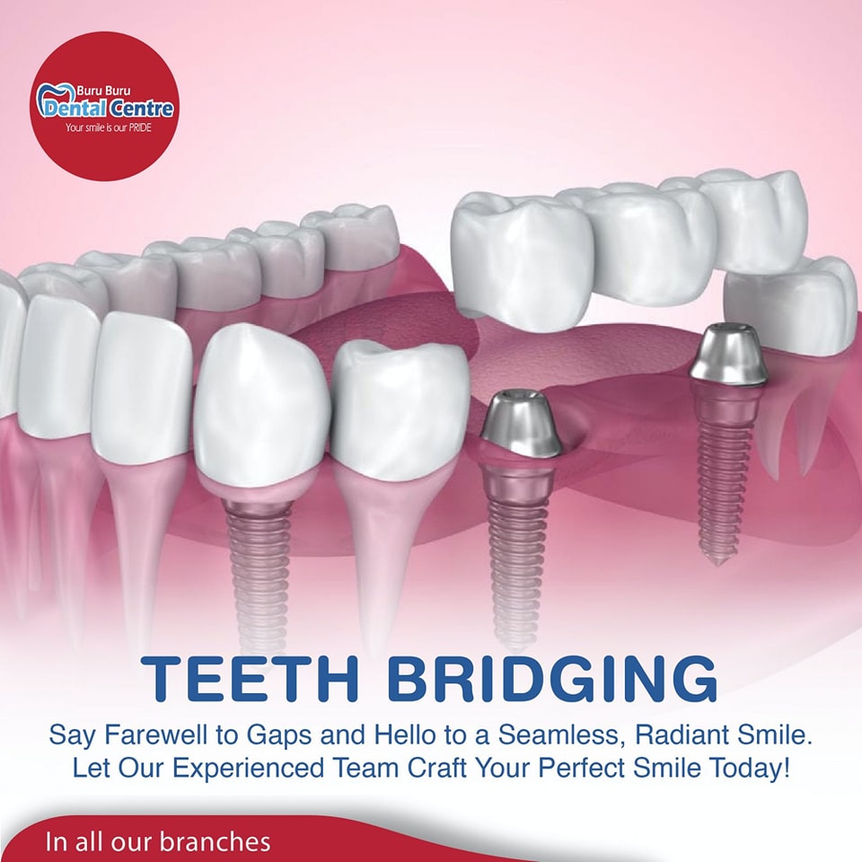 Benefits of Dental Bridging